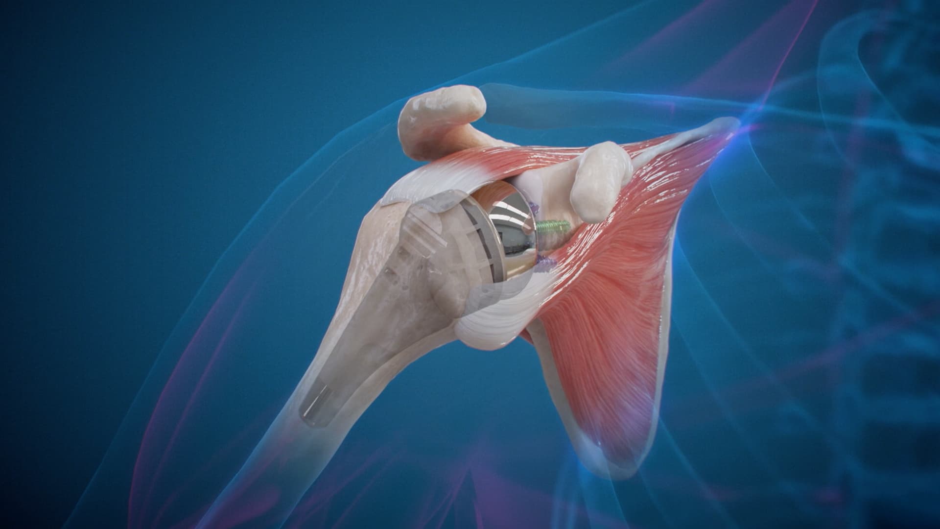 Arthrex Shoulder Software cover image